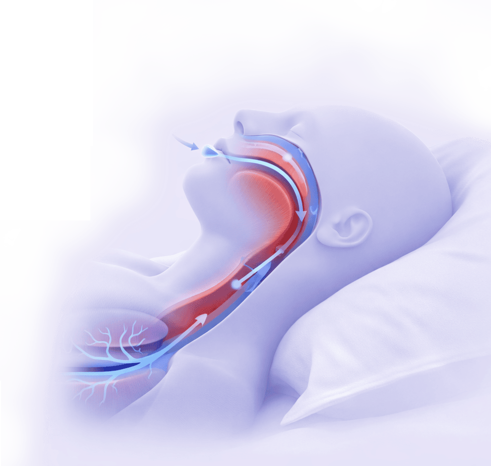 Ilustrasi saluran napas yang menyempit saat sleep apnea